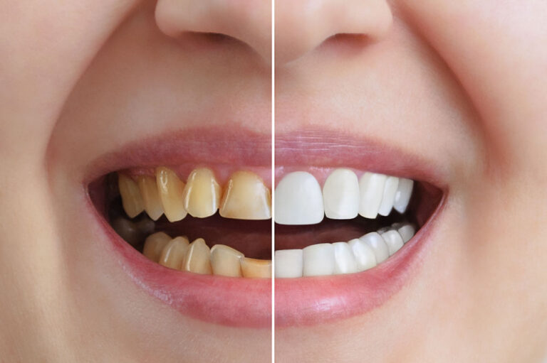 treatment and whitening of teeth, dental crowns. before and after. dentistry. close up.
